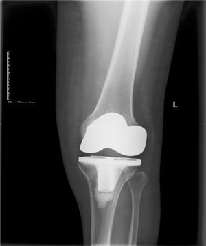 人工膝关节置换手术（术前术后）